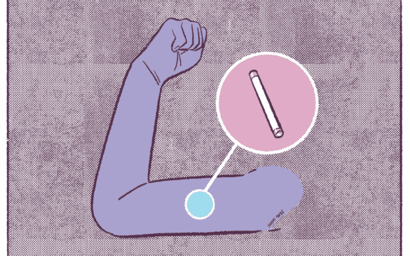 Hablemos de anticonceptivos: el implante.