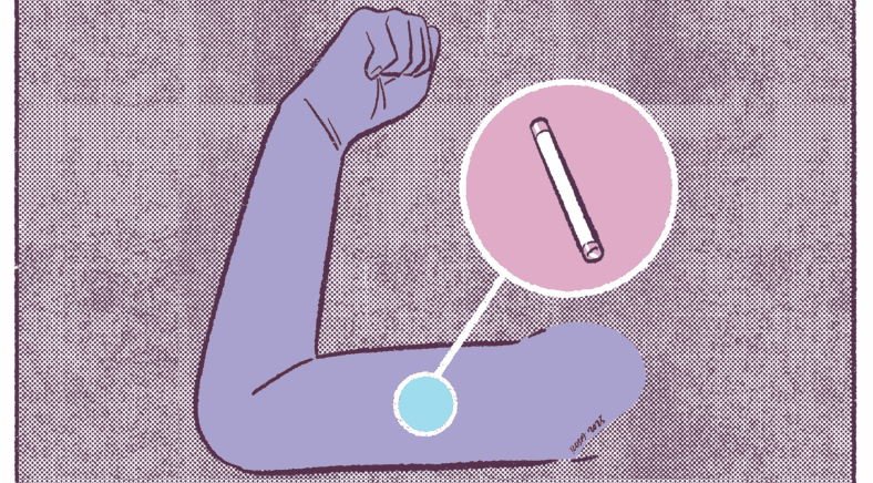 Hablemos de anticonceptivos: el implante.